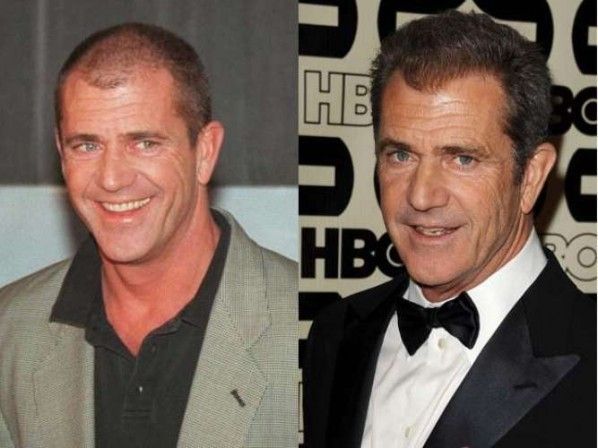 Mel Gibson trasplante capilar