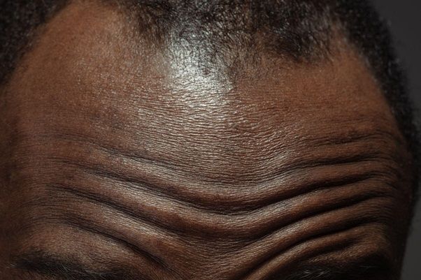 La alopecia por tracción en África