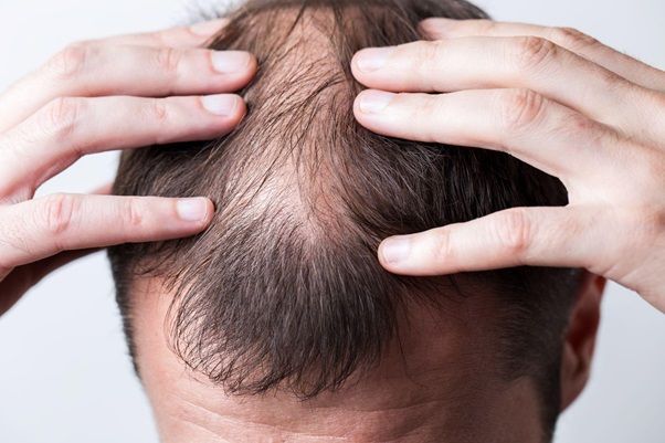 Alopecia areata