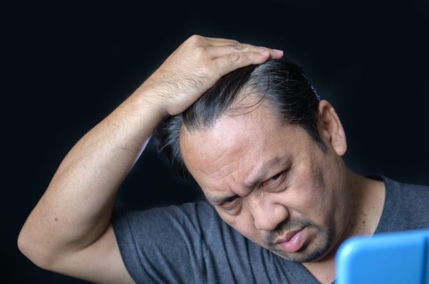 Alopecia en países asiáticos