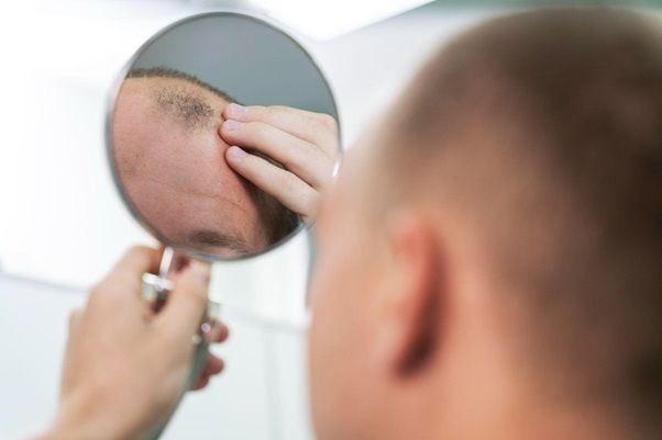 Estadísticas de la alopecia