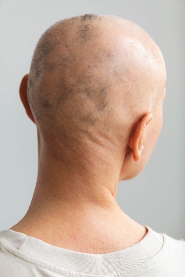La alopecia en mujeres