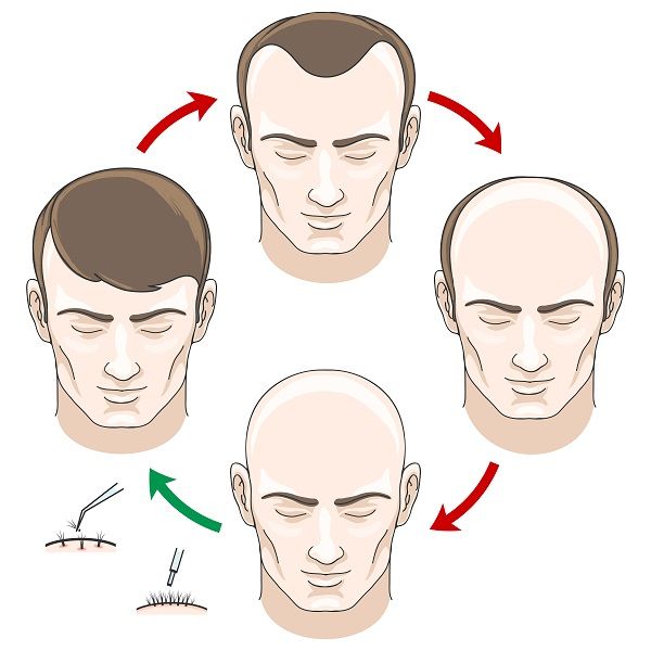 Etapas de la alopecia