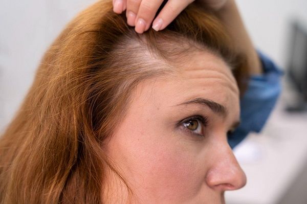 Comprendiendo la alopecia femenina