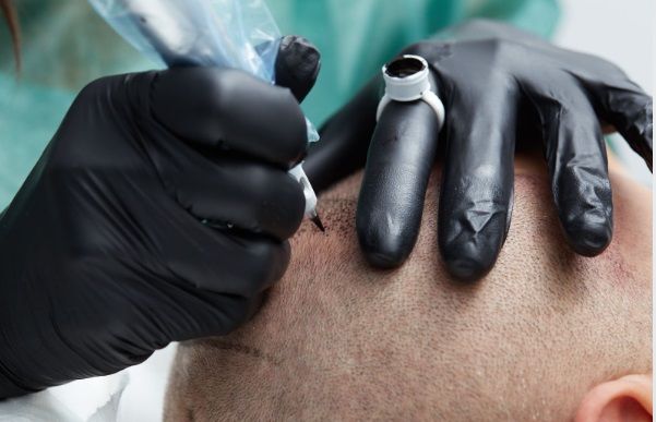 Operación de trasplante capilar llevada a cabo por un cirujano