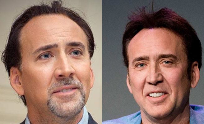 Nicolas Cage trasplante capilar