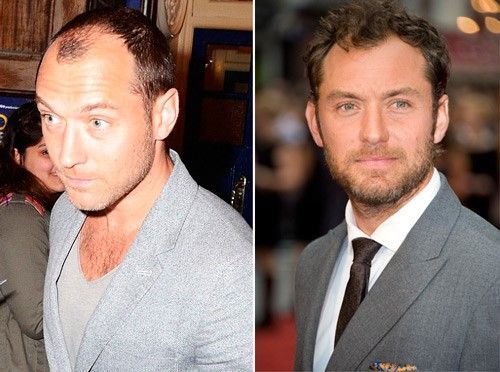 Jude Law trasplante capilar