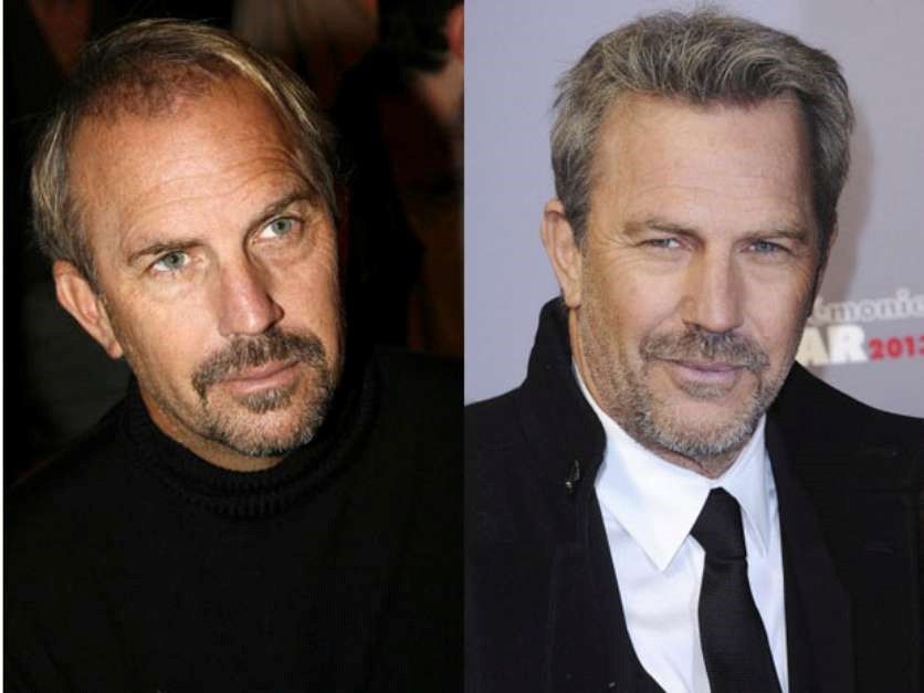Kevin Costner trasplante capilar