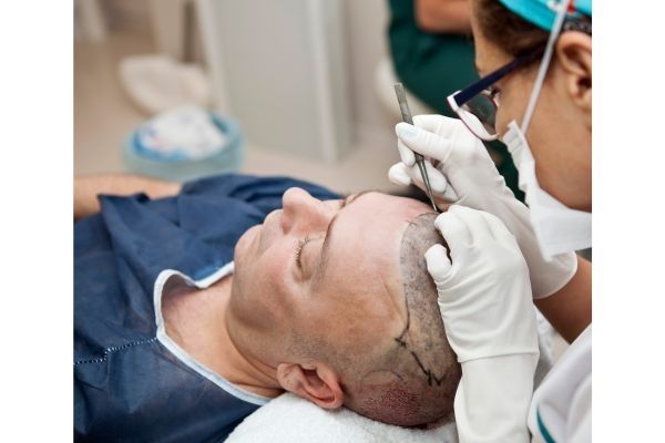 Doctora realizando incisiones para el injerto capilar