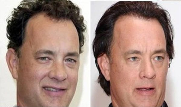 Tom Hanks imagen de antes y después de su trasplante capilar