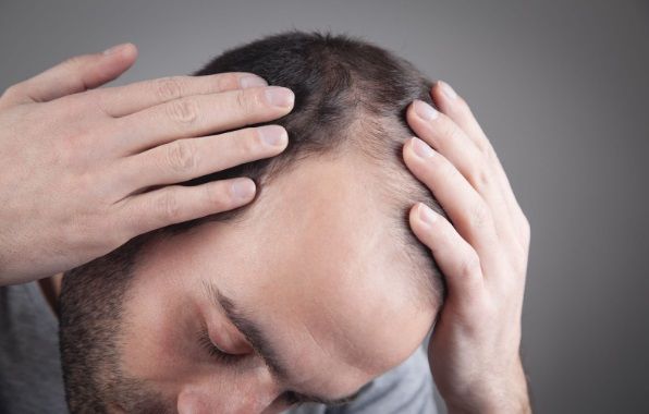 Hombre que sufre alopecia mostrando su cuero cabelludo