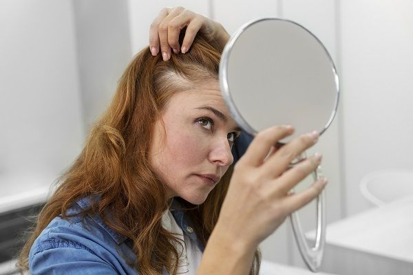 Mujer mirándose al espejo la alopecia androgénica