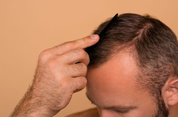 Hombre peinándose el pelo mostrando su alopecia