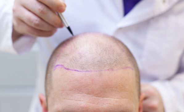 Cirujano haciendo un diagnóstico de alopecia y de intervención de trasplante capilar