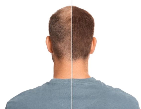 Hombre de espaldas mostrando antes y después del injerto capilar