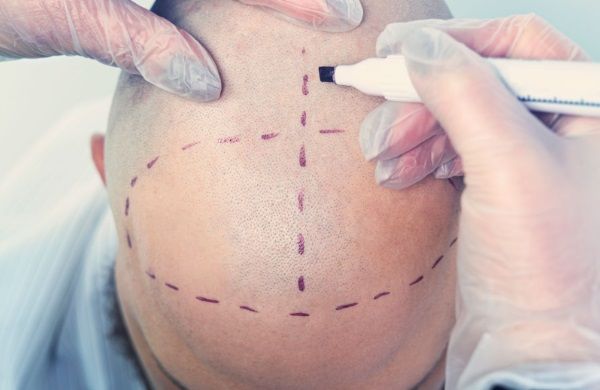 Cirujano capilar marcando la cabeza del paciente para realizarle el injerto capilar