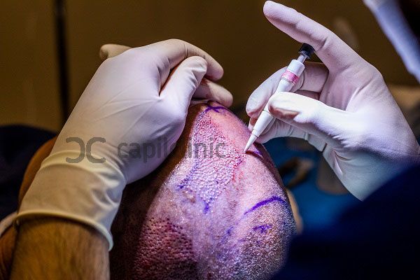 Microinjerto capilar realizado por cirujano