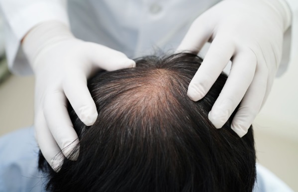Cirujano capilar revisando cabello de hombre con principio de alopecia