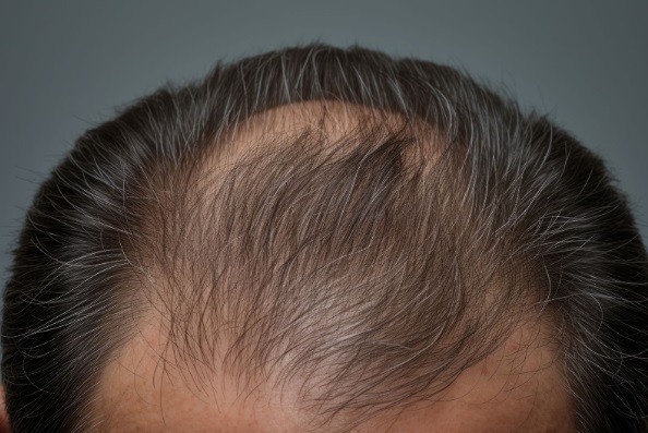 Cabeza de hombre con alopecia preparado para la planificación de la operación