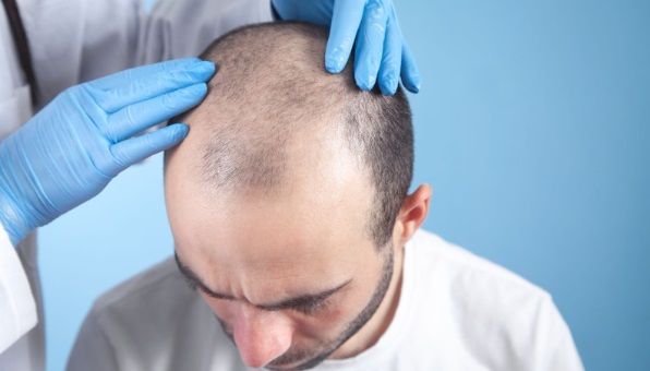 Médico revisando la calvicie de un paciente