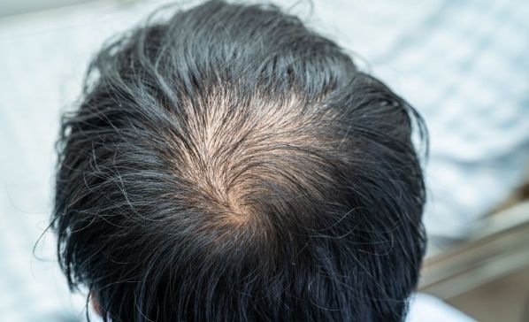 Hombre de espaldas dónde se le ve el inicio de la alopecia en la coronilla