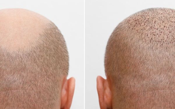 Antes y después de un trasplante capilar