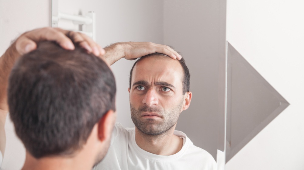 Hombre con alopecia mirándose en el espejo