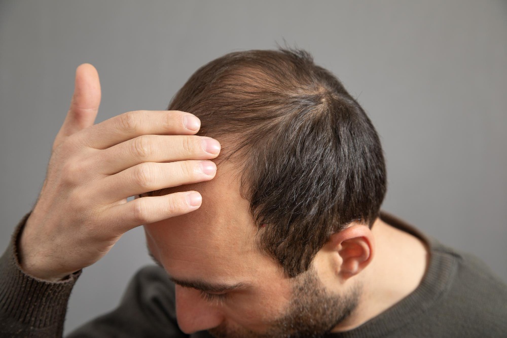 Hombre tocándose el pelo mostrando su alopecia
