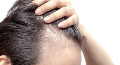 entradas en el pelo