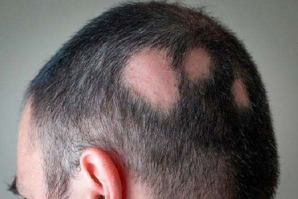 Hombre que tiene alopecia areata en la parte trasera de la cabeza