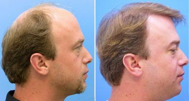 implantes de pelo en Barcelona