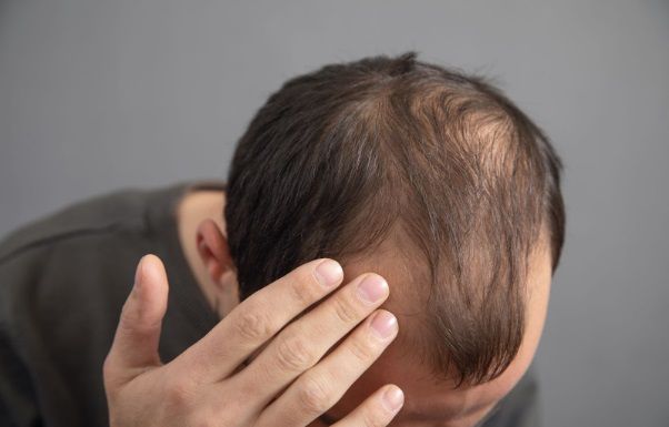 Hombre con la mano en la cabeza al que se le está cayendo el pelo