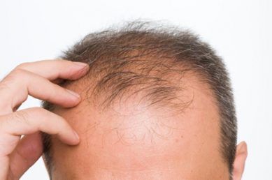 país para trasplannte de pelo