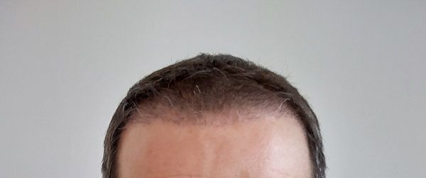 Imagen frontal de un trasplante capilar 3 meses después