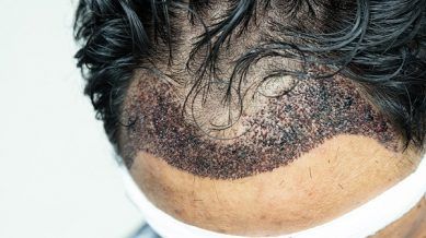 Un trasplante capilar infectado
