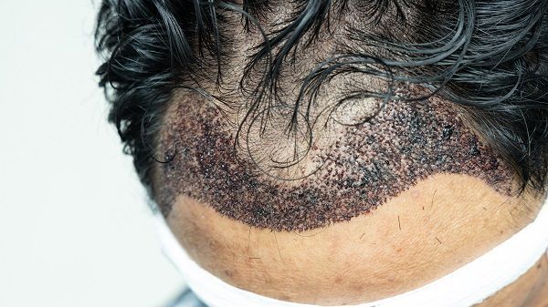 Un trasplante capilar infectado
