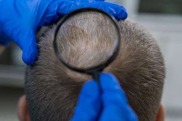 Especialista mirando con lupa el cabello para ver la salud capilar del paciente