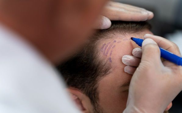 Doctor marcando con rotulador la línea frontal del paciente