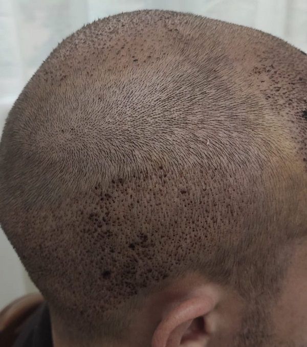 Día 4 después del trasplante capilar