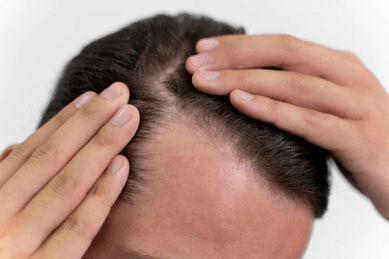injerto de pelo