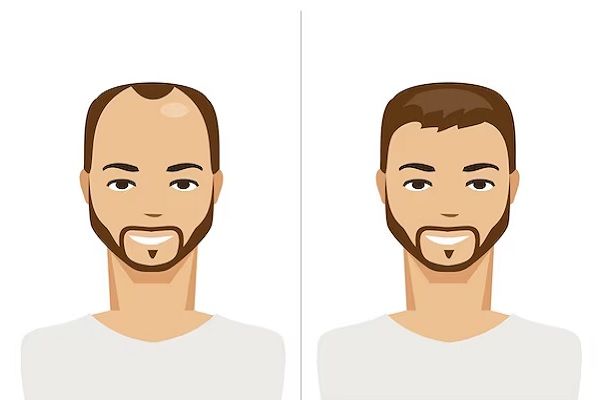 Sistema de integración capilar 