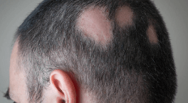 Paciente de alopecia areata