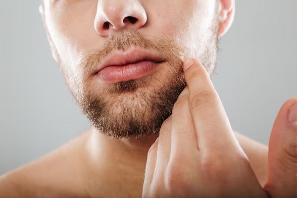 injerto de barba