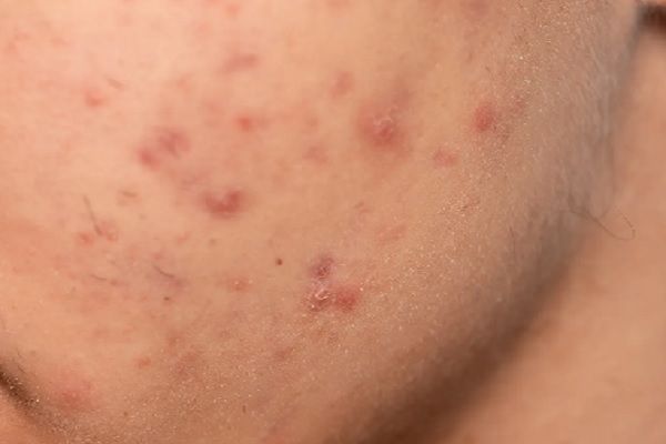 Alopecia frontal fibrosante