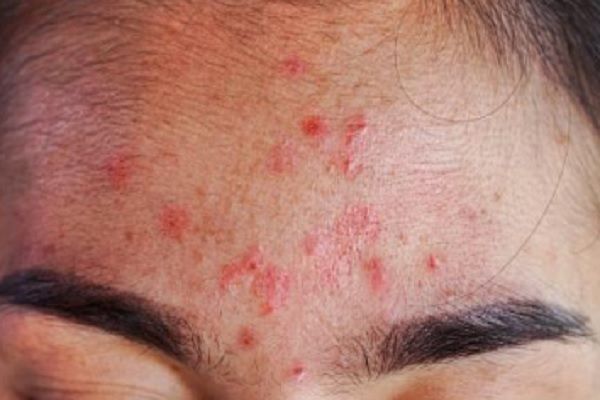 Alopecia frontal fibrosante