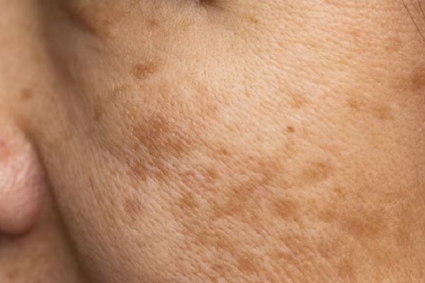 Alopecia frontal fibrosante
