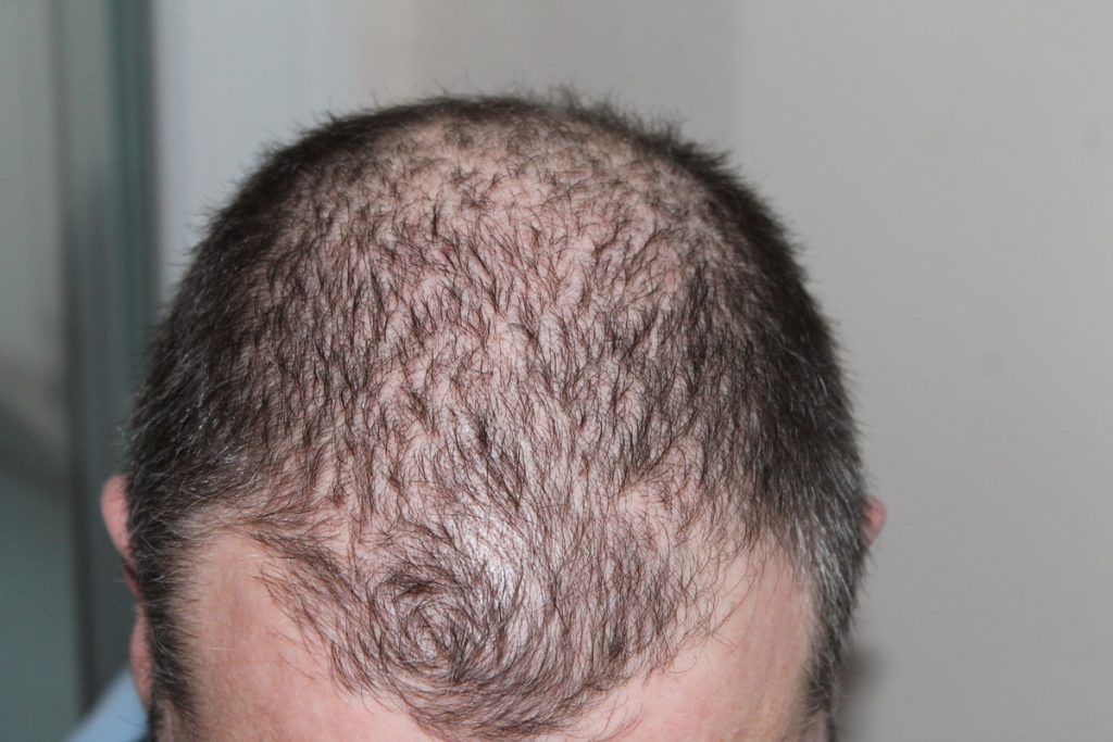 Cómo evitar la caída del pelo