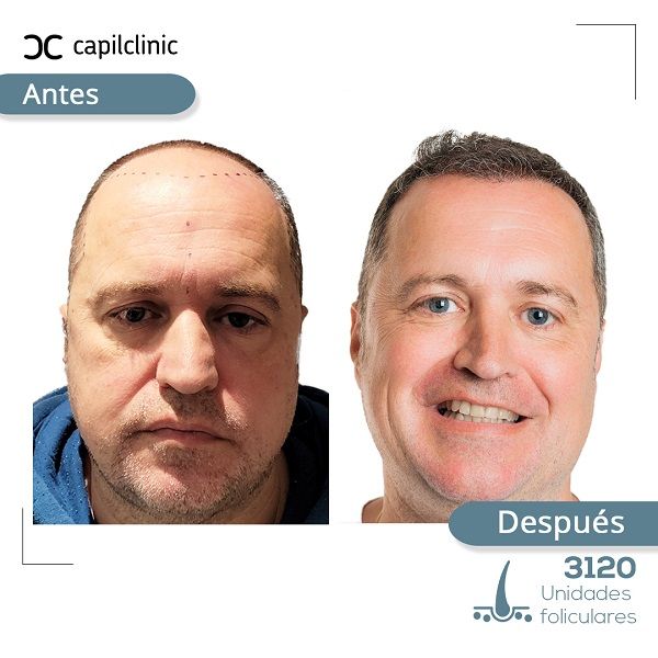 Fotos antes y después de paciente sometido a trasplante capilar FUE zafiro