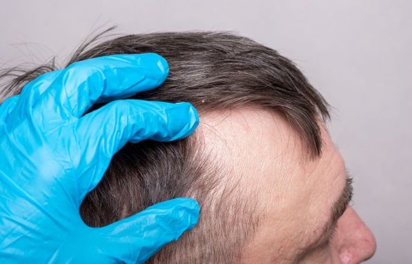 Médico revisando la cabeza de un paciente para ver si apto para un trasplante capilar