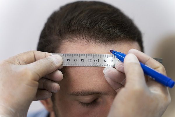 Médico revisando el cabello de un paciente para ver cómo realizará el trasplante con técnica MicroFUE